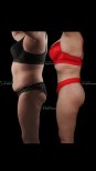 Before and after full body lift results at Renaissance Clinic – improved body contour visible