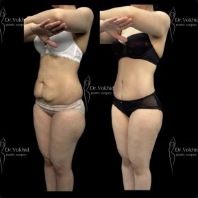 Before and after abdominal liposuction results at Renaissance Clinic, improved body contour