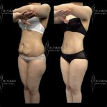 Before and after abdominal liposuction results at Renaissance Clinic, improved body contour