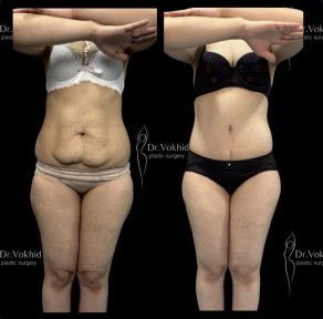 Before and after abdominal liposuction results at Renaissance Clinic, improved body contour