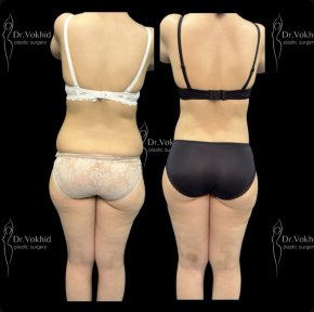 Before and after abdominal liposuction result at Renaissance Clinic, improved body contour