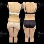 Before and after abdominal liposuction result at Renaissance Clinic, improved body contour