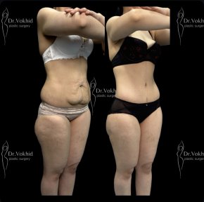 Before and after abdominal liposuction at Renaissance Clinic, visible body contouring result