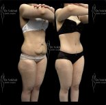 Before and after abdominal liposuction at Renaissance Clinic, visible body contouring result