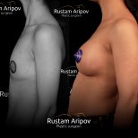 Before and after mammoplasty results at Renaissance Clinic, visible breast augmentation outcome