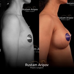 Before and after mammoplasty results at Renaissance Clinic, visible breast augmentation outcome