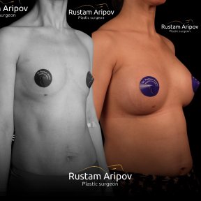 Before and after mammoplasty results at Renaissance Clinic, visible breast augmentation outcome