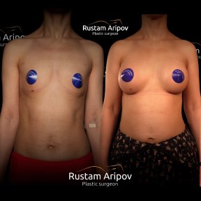 Before and after mammoplasty results at Renaissance Clinic, visible breast augmentation outcome