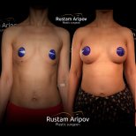 Before and after mammoplasty results at Renaissance Clinic, visible breast augmentation outcome