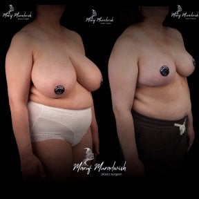 Before and after breast reduction results at Renaissance Clinic, improved breast contour