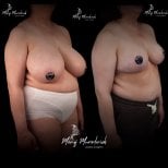 Before and after breast reduction results at Renaissance Clinic, improved breast contour