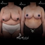 Before and after breast reduction results at Renaissance Clinic, visible size and shape improvement