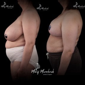 Before and after breast reduction results at Renaissance Clinic, improved breast contour visible