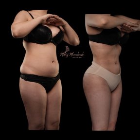 Before and after liposuction results at Renaissance Clinic, visible body contour improvement