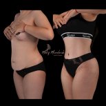 Before and after liposuction results at Renaissance Clinic – improved waist and abdomen contour