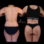 Before and after liposuction results at Renaissance Clinic, visible waist and back contouring