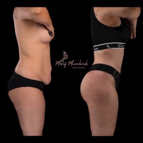 Before and after liposuction at Renaissance Clinic, visible abdominal contouring result