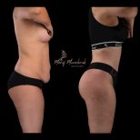Before and after liposuction at Renaissance Clinic, visible abdominal contouring result