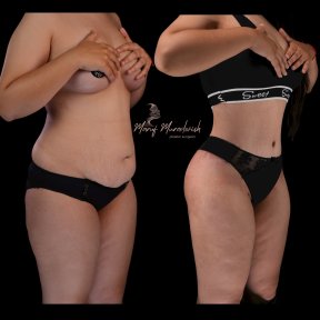 Before and after liposuction results at Renaissance Clinic – visible waist and abdomen contouring