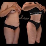 Before and after liposuction results at Renaissance Clinic – visible waist and abdomen contouring