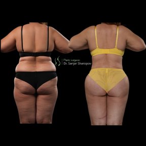 Before and after Body Jet liposuction results at Renaissance Clinic, improved body contour