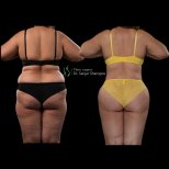 Before and after Body Jet liposuction results at Renaissance Clinic, improved body contour