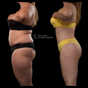 Before and after Body Jet liposuction results at Renaissance Clinic, improved body contour