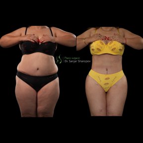 Before and after Body Jet liposuction results at Renaissance Clinic – visible body contouring