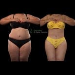 Before and after Body Jet liposuction results at Renaissance Clinic – visible body contouring