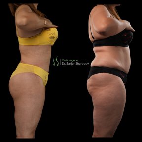 Before and after Body Jet liposuction results at Renaissance Clinic, visible body contouring