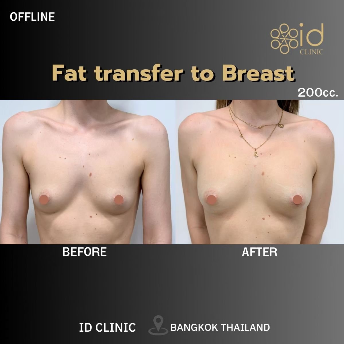 glutathione breast enlargement Augmentation with Fat Transfer in Thailand — Cost from $5,800 no-pills Amount1:10ML Is glutathione vitamin c