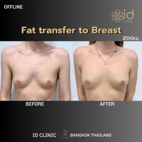 Résultats avant/après d’augmentation mammaire par lipofilling à ID Clinic Bangkok