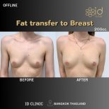 Résultats avant/après d’augmentation mammaire par lipofilling à ID Clinic Bangkok