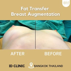 Résultats avant et après augmentation mammaire par lipofilling à ID Clinic Bangkok