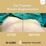 Résultats avant et après augmentation mammaire par lipofilling à ID Clinic Bangkok