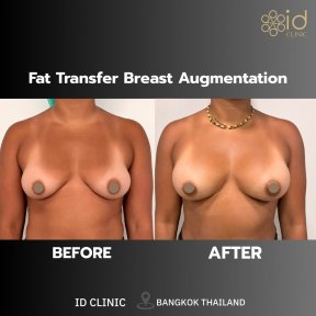 Résultats avant et après augmentation mammaire par lipofilling à ID Clinic Bangkok