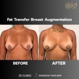 Résultats avant et après augmentation mammaire par lipofilling à ID Clinic Bangkok