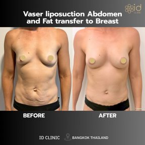 Avant/après augmentation mammaire par lipofilling à ID Clinic Bangkok, résultat visible