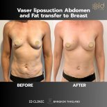 Avant/après augmentation mammaire par lipofilling à ID Clinic Bangkok, résultat visible