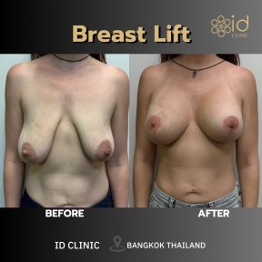 Résultats avant/après lifting mammaire à ID Clinic Bangkok – forme et remontée améliorées