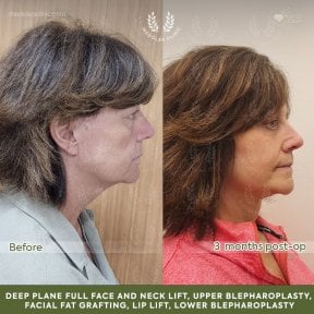 Результаты до и после фейслифтинга и подтяжки шеи в клинике Dr. Safa Manav, омоложение