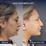 Результаты до и после фейслифтинга и подтяжки шеи в Dr. Safa Manav Clinic, видимое подтяжение кожи