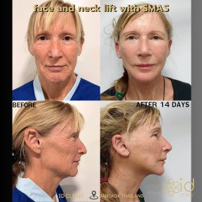 before-after photo tightening-of-facial-skin-facelift
