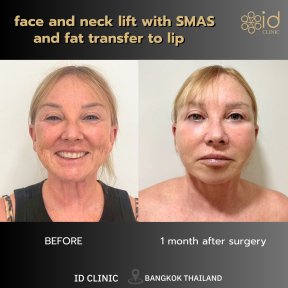 before-after photo tightening-of-facial-skin-facelift