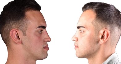 before-after photo chin-implants