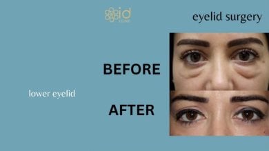 before-after photo lower-eyelid-surgery