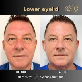 before-after photo lower-eyelid-surgery