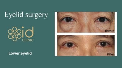 before-after photo lower-eyelid-surgery