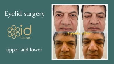 before-after photo lower-eyelid-surgery