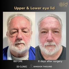 before-after photo lower-eyelid-surgery